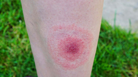 Samento for Lyme Disease visible on a leg with a round rash indicating possible Lyme disease symptoms.