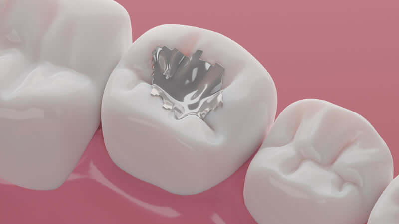 Close-up of dental work showcasing metal filling highlighting toxic effects of dentistry.