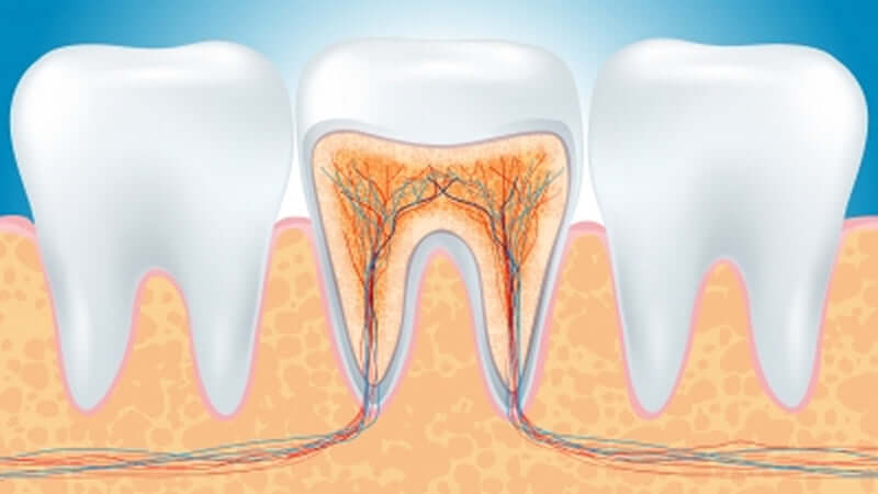 Root Canal Cover-Up