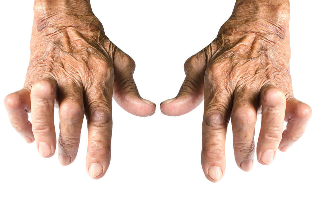 Natural Relief for Rheumatoid Arthritis