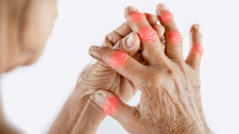 Hands with visible signs of pain and inflammation related to Arthritis and Rheumatism.
