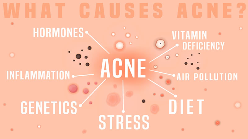 Acne Causes