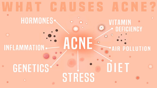 Acne Causes