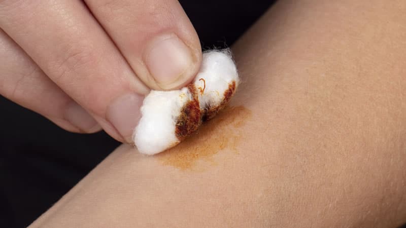 person performing Iodine Skin Test on arm with cotton ball and iodine stain