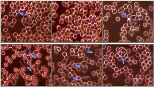 Live Blood Analysis and Nattokinase