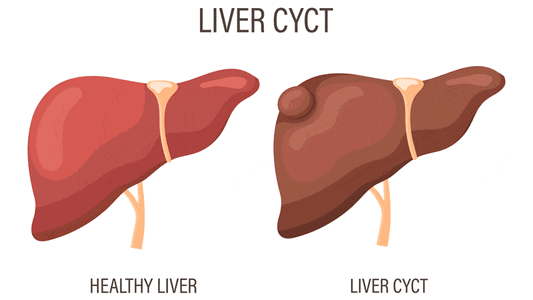 Liver Cysts