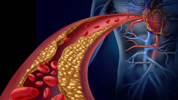 Reverse Arteriosclerosis
