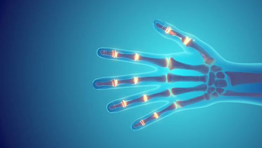 Rheumatoid Arthritis: Cabot