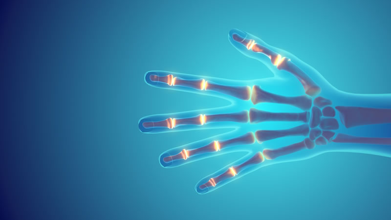 Rheumatoid Arthritis: Cabot