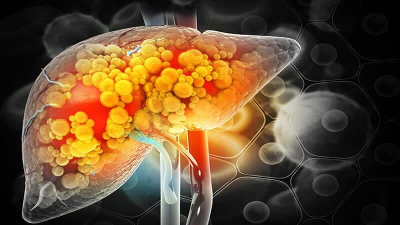 Liver Disease