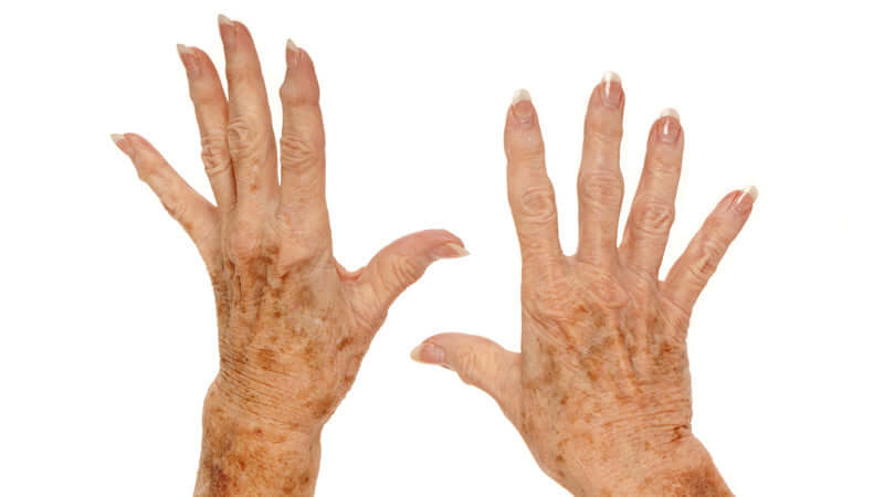 Liver Spots