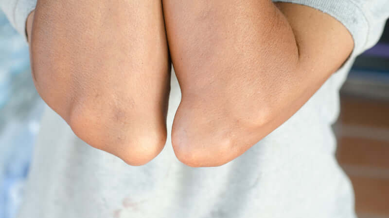 Gout Basics
