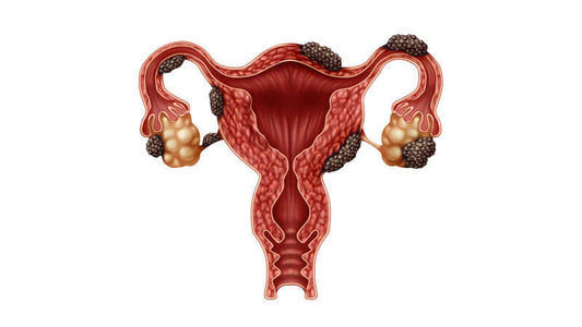 Illustration of human uterus showing endometriosis with lesions on the reproductive organs.