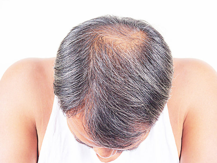 Hair Loss and Quality