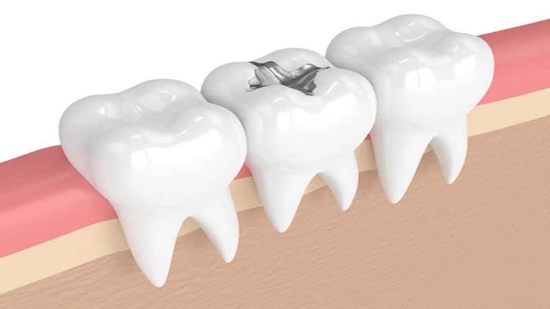 Dental Mercury Amalgam Filling