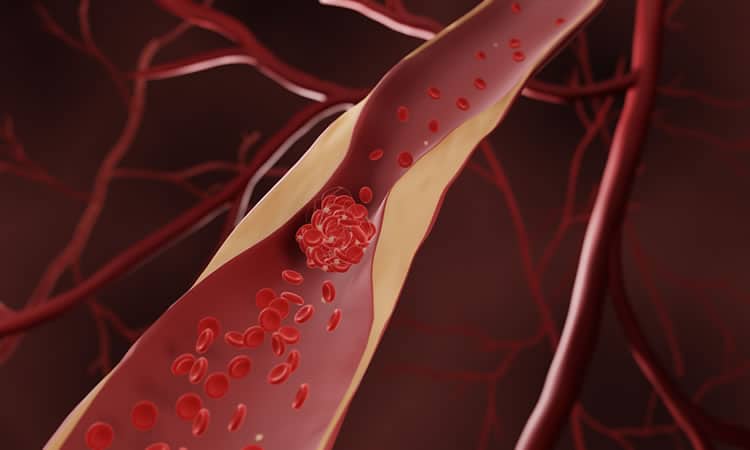 Atherosclerosis, blood clot in artery