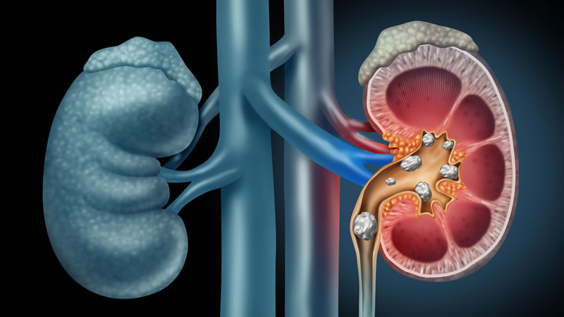 Kidney Stones illustrated