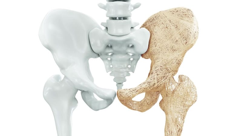 Osteoporosis in pelvic bones