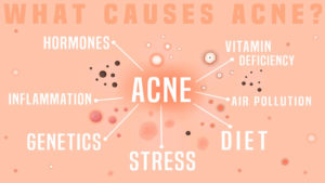 Acne Causes, hormones, inflammation, diet, stress